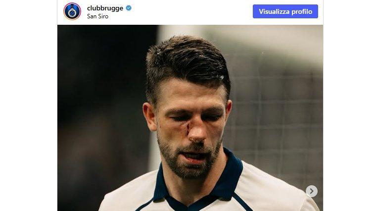 Mechele resta in campo con il naso rotto. E il Brugge lo esalta