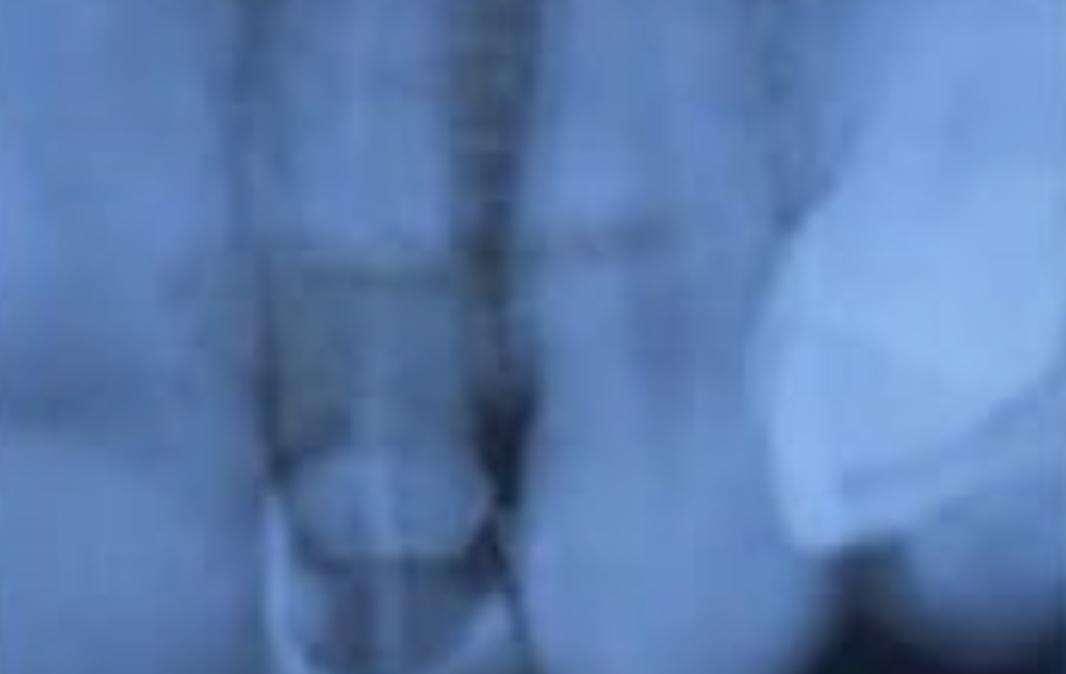 Flamengo, piccolo incidente per Gabriel Barbosa: dente fratturato dopo una gomitata