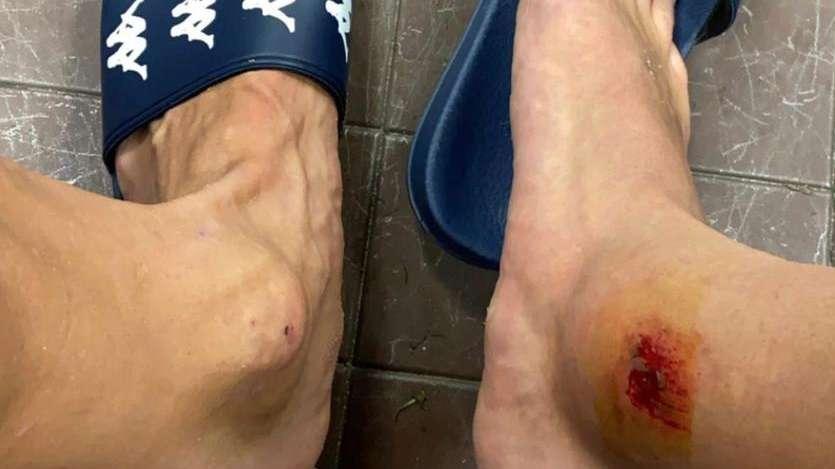 FOTO, Lirola sui social mostra la caviglia tumefatta