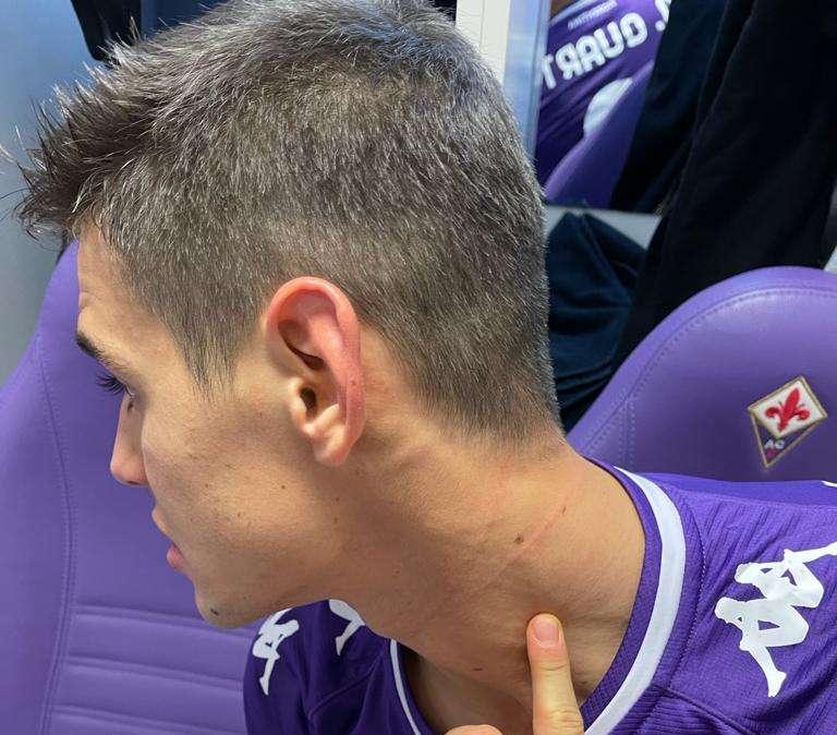 FOTO FV, Il graffio su M. Quarta di Lukaku al 119'