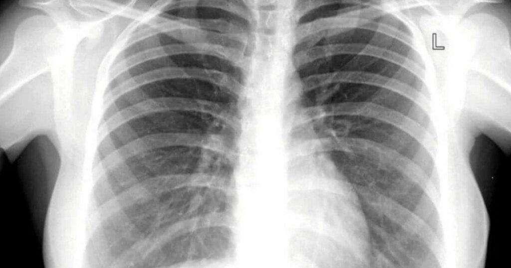 NEWS | Tubercolosi, aumentano i casi: il Lazio tra le regioni più colpite