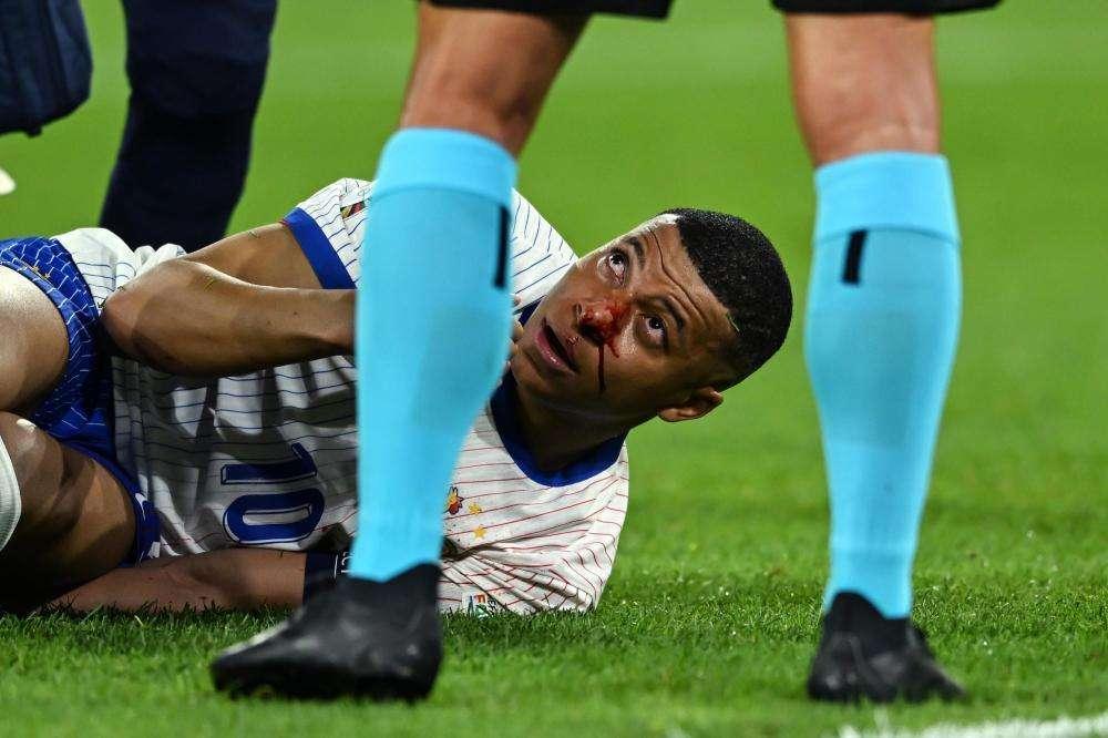 Francia, monta il "caso" Mbappe. Setto nasale rotto ma niente operazione, giocherà con una mascherina?