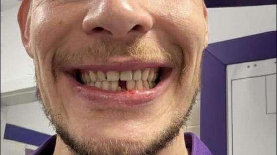 FOTO - Belotti, l'attaccante ha perso un dente nella sfida con l'Atalanta