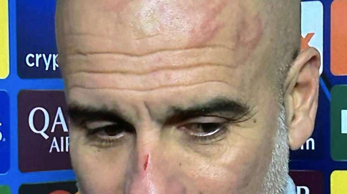 L’incredibile nervosismo di Guardiola, naso e testa piena di graffi: “Le mie unghie…”