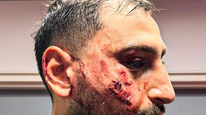 Infortunio shock per Donnarumma: volto sfregiato da Singo