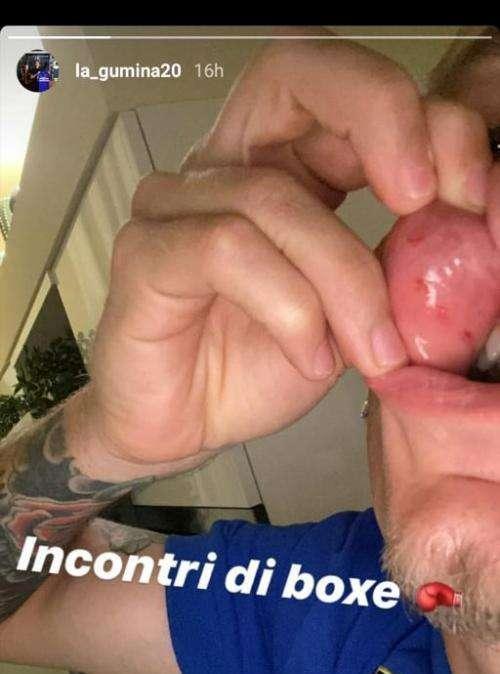 FOTO - Samp, La Gumina fa vedere i segni del pugno di Danilo: "Incontri di boxe"