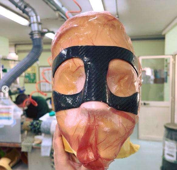 Dott. Ruggiero: "Meret si è rotto il setto nasale! Ecco per quanto dovrà indossare la maschera"