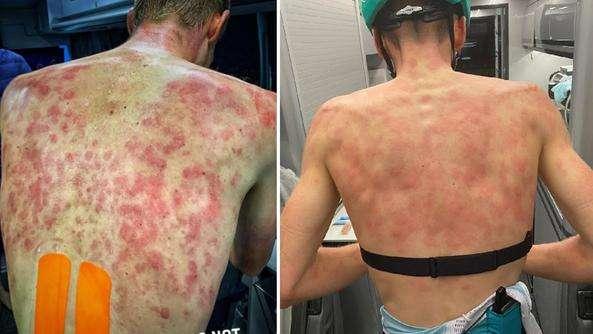 Così la grandinata ha martoriato la schiena dei ciclisti in gara al giro del Delfinato