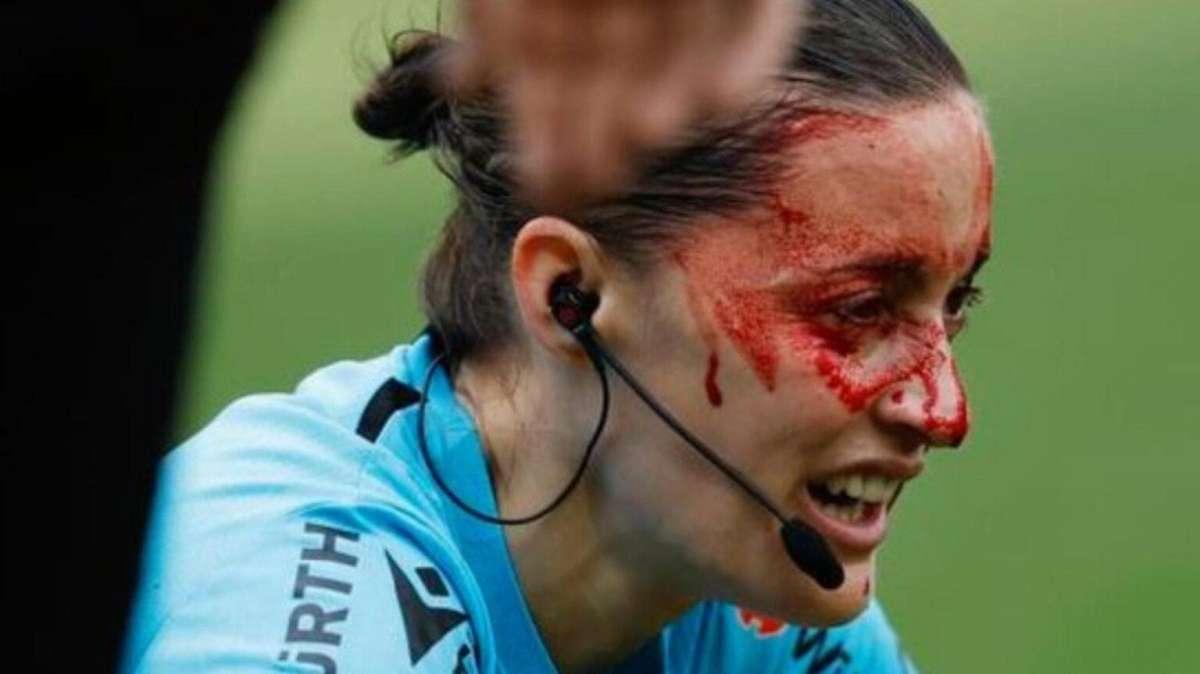 Spagna, la guardalinee è una maschera di sangue dopo lo scontro con una telecamera